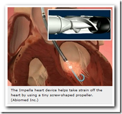 Ancient Principle Fuels Modern Heart Device - Medical Quack